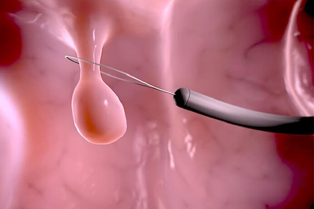 Phẫu thuật cắt bỏ bằng phương pháp nội soi có thể được thực hiện nếu có polyp kích thước lớn