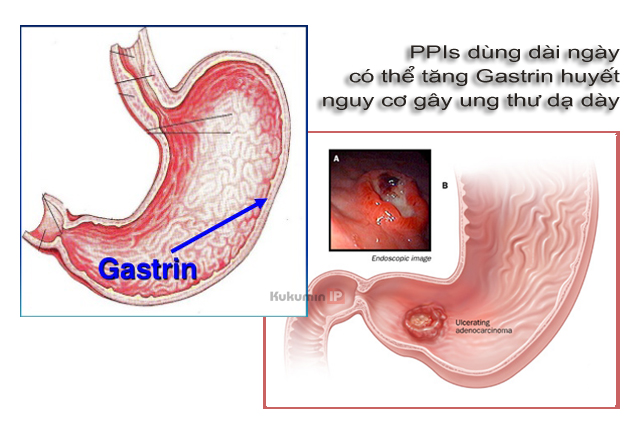 tác dụng phụ PPIs làm tăng Gastrin huyết