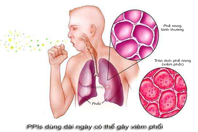 tác dụng phụ PPIs gây viêm phổi