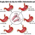 Vai trò của Helicobacter pylori trong ung thư dạ dày – phần 2