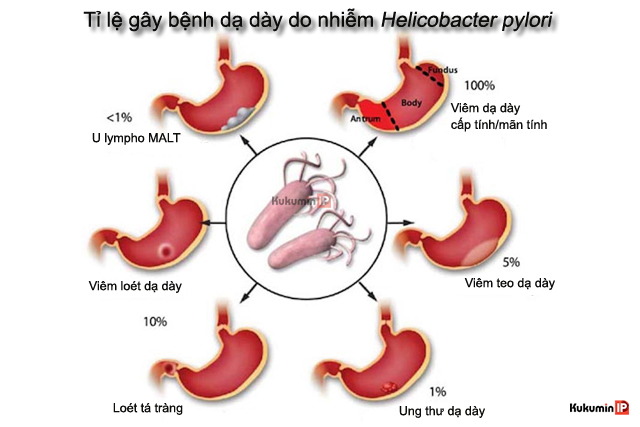 H. pylori gây ung thư dạ dày và các bệnh dạ dày khác